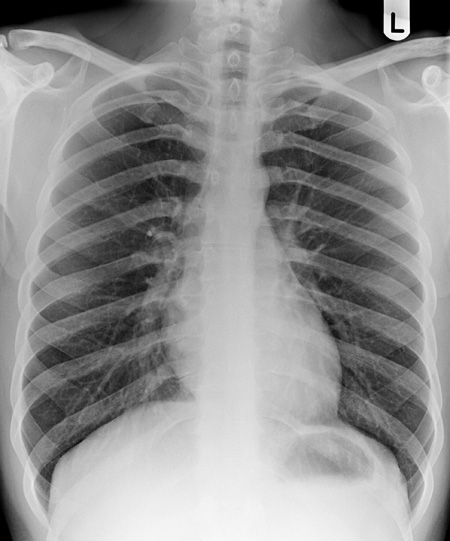 Lunge röntgenbild weiße flecken