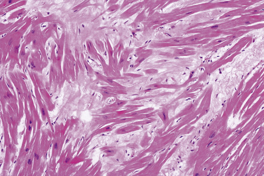 hypertrophe Kardiomyopathie