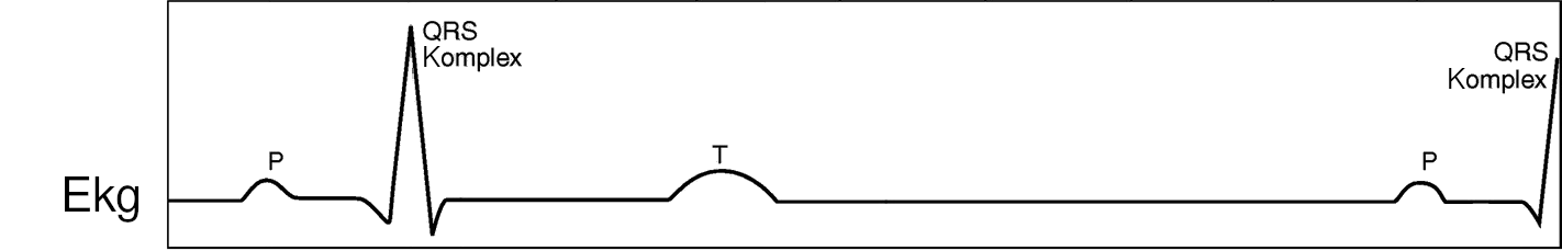 hier fehlt das Ekg-Bild