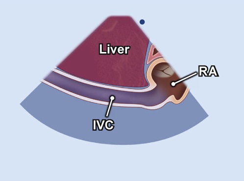 subkostale Schnittebene