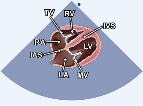 subkostale Schnittebene