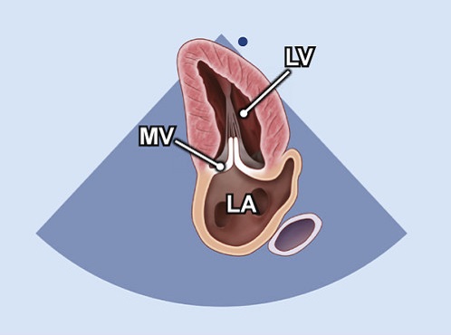 subcostale Schnittebene